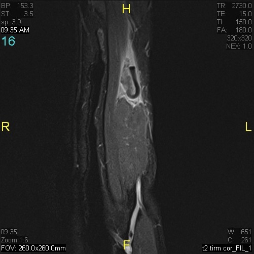 Figure 4 for case Rupture of tendon of long head of biceps brachii ( RID1944 )